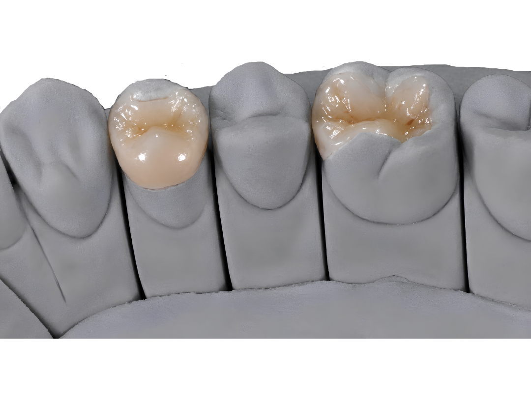 Ceramic inlays and onlays seated on a sectioned die model