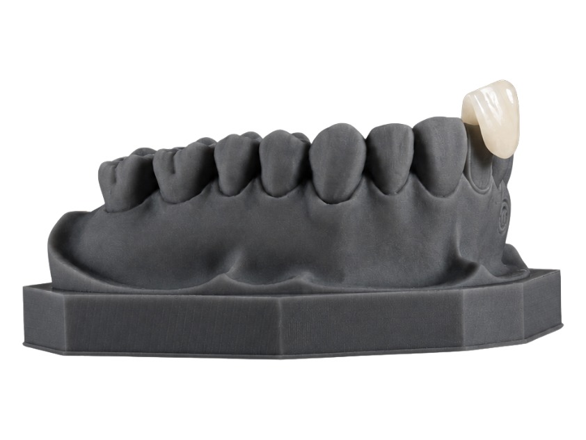 An all-ceramic jacket crown on an anterior die