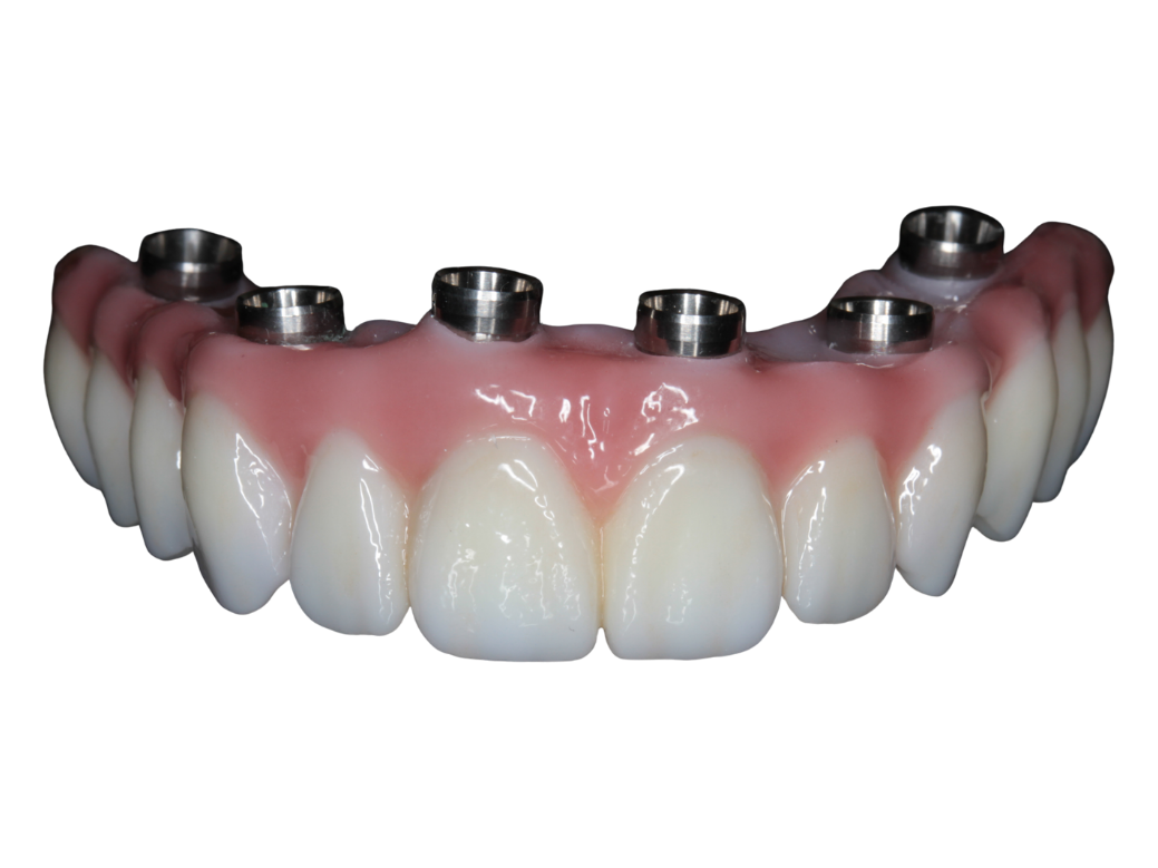 A screw-retained implant restoration with visible access channels