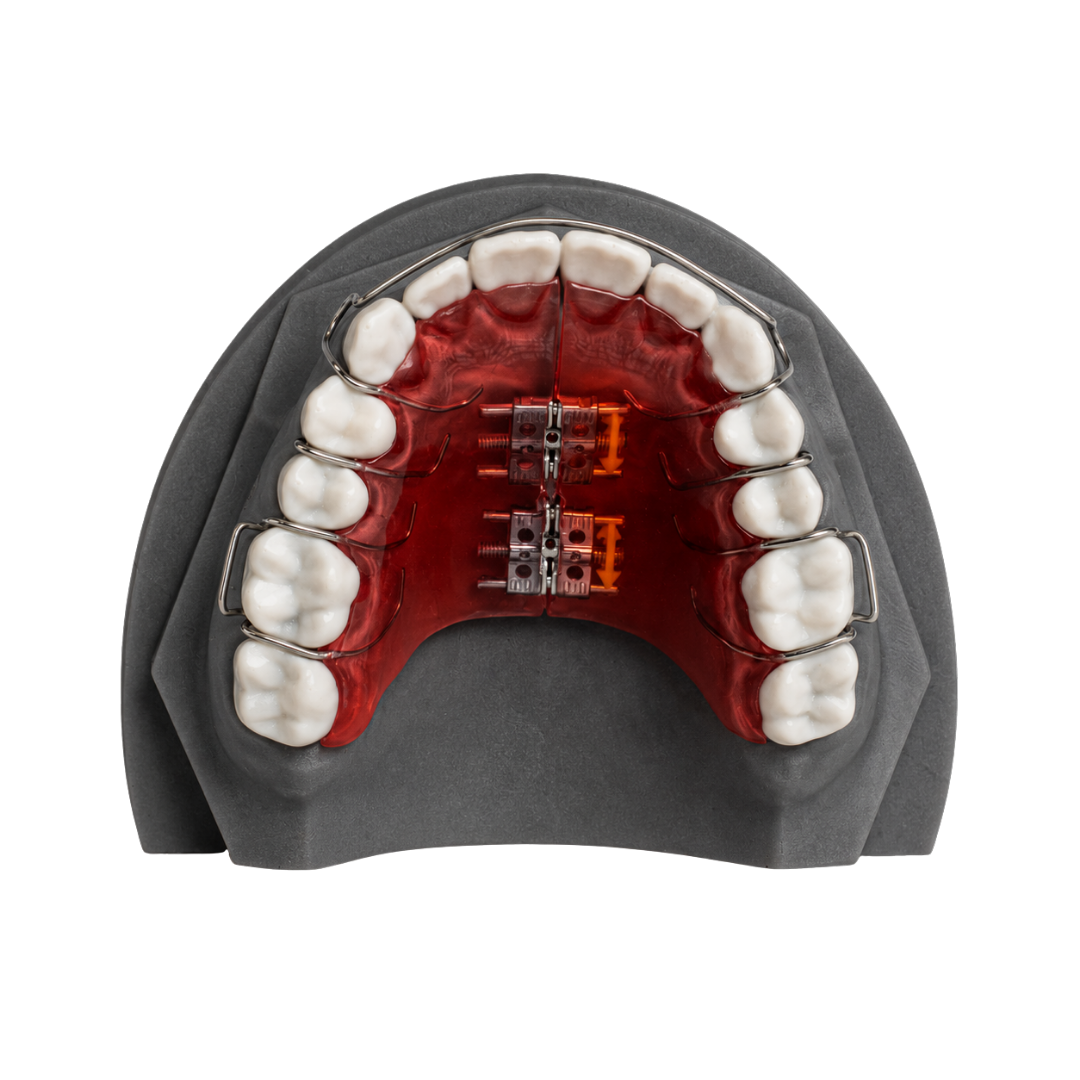 A palatal expander on an upper model