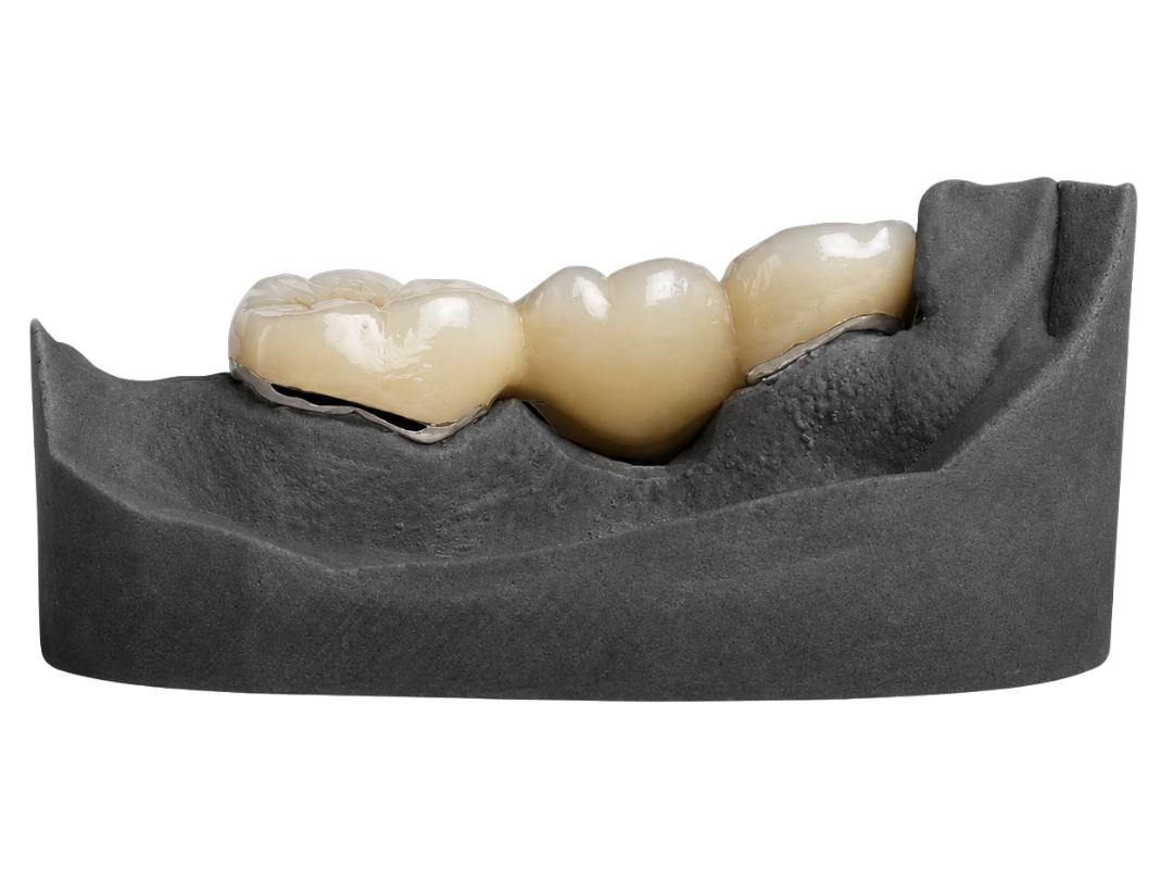 A porcelain-fused-to-metal bridge on a sectioned model