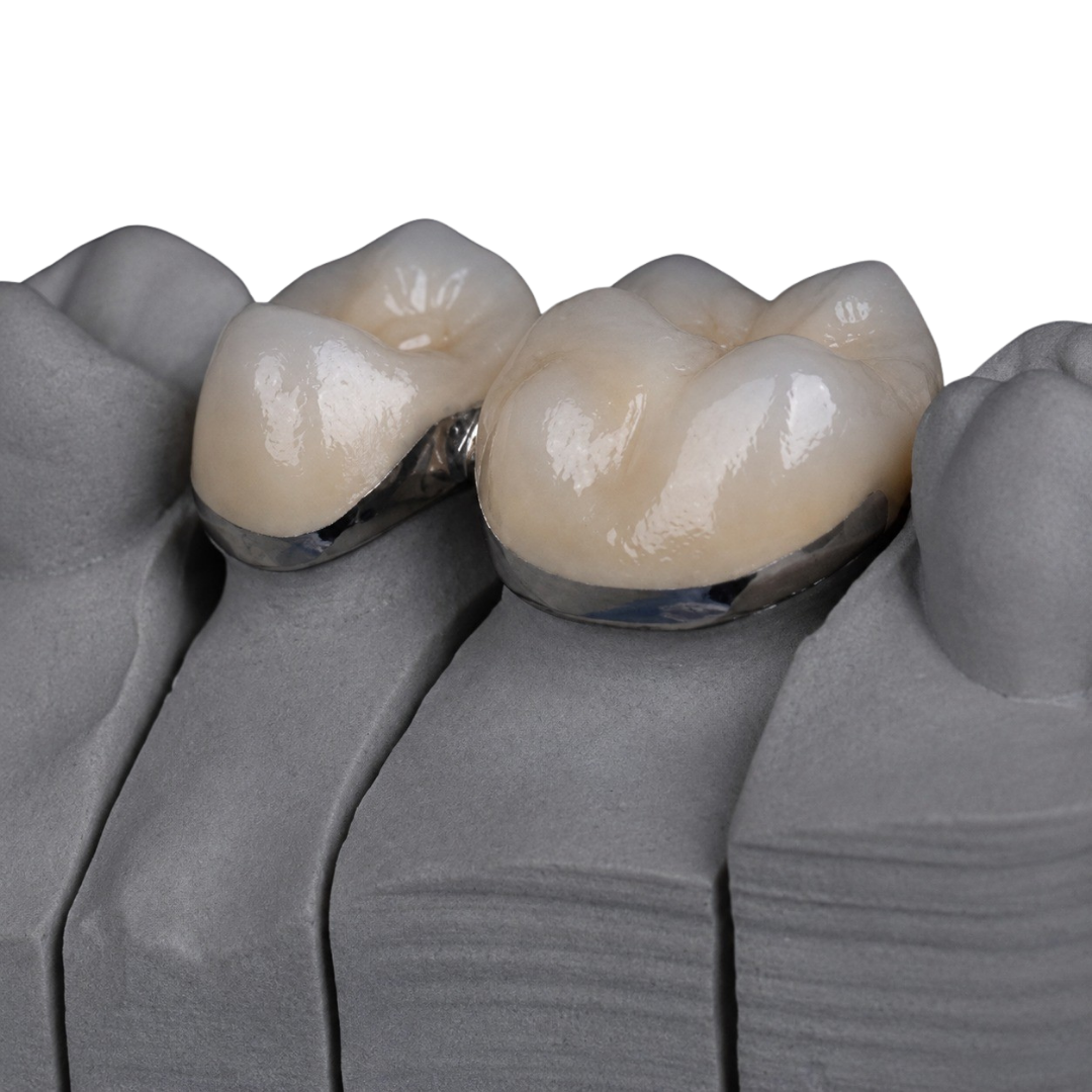 A porcelain-fused-to-metal crown on a die