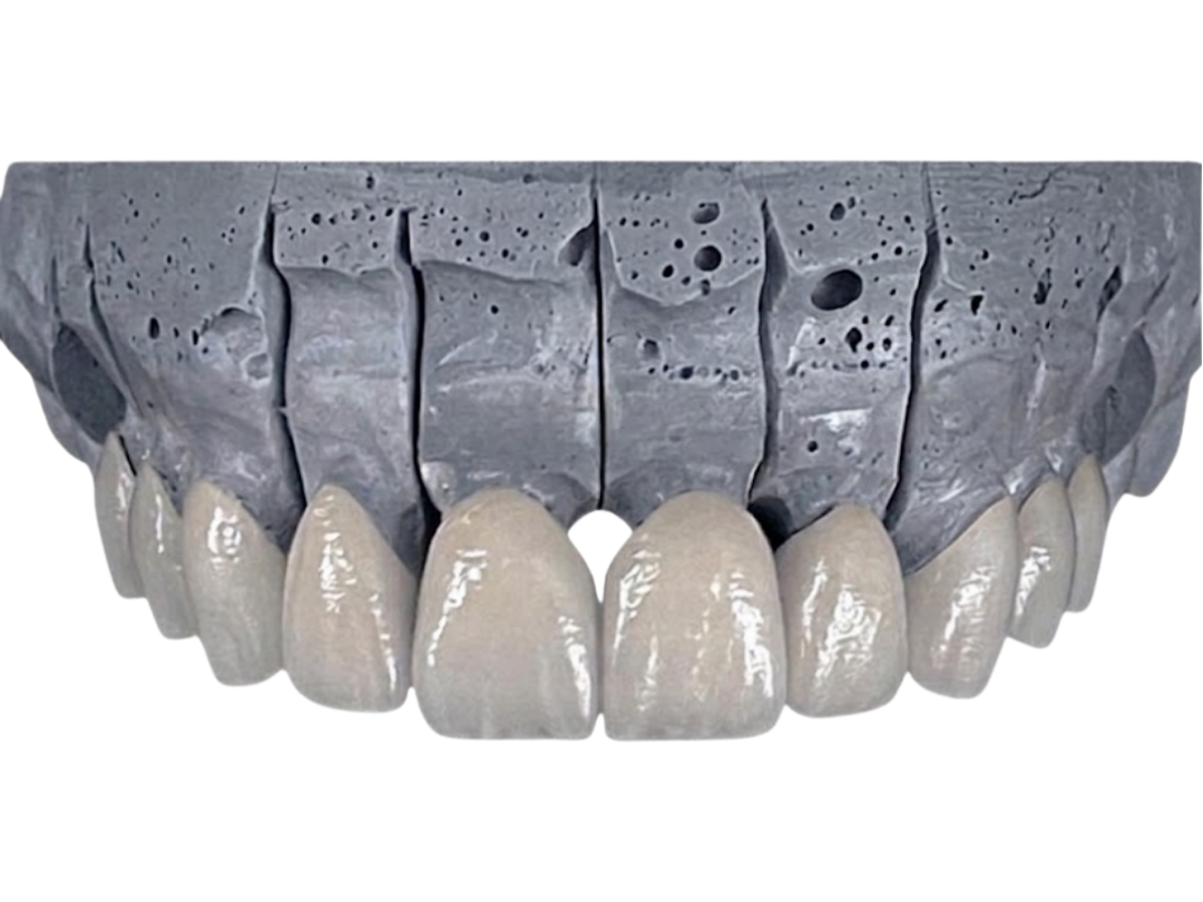 A full-arch porcelain-fused-to-metal restoration
