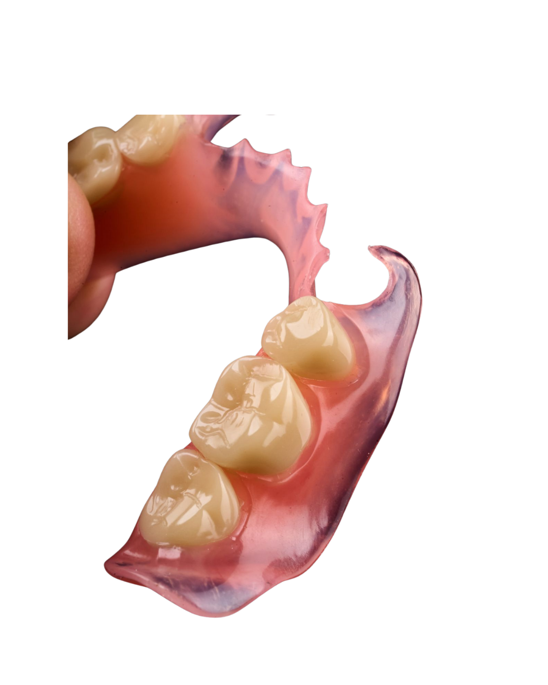 A flexible partial denture with tooth-coloured clasps, view 2
