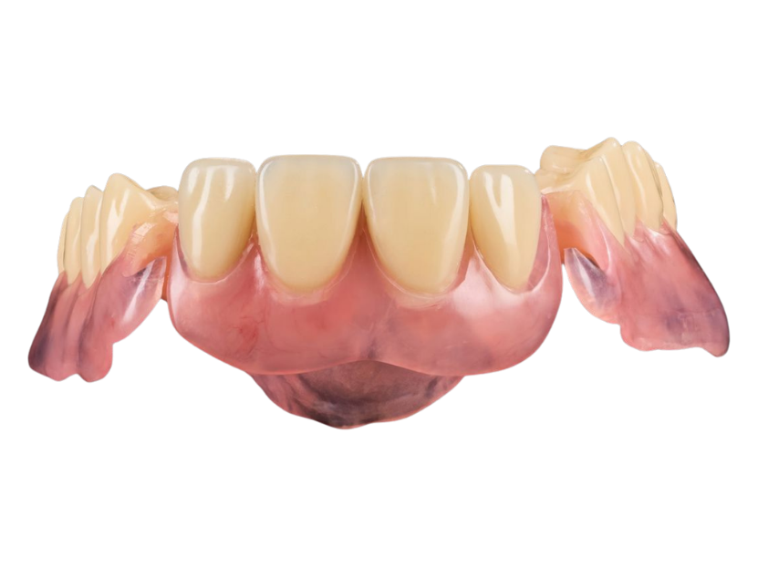 A flexible partial denture with tooth-coloured clasps, view 3