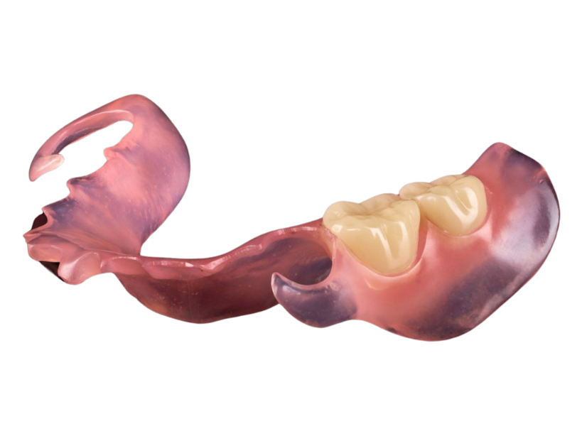 A flexible partial denture with tooth-coloured clasps