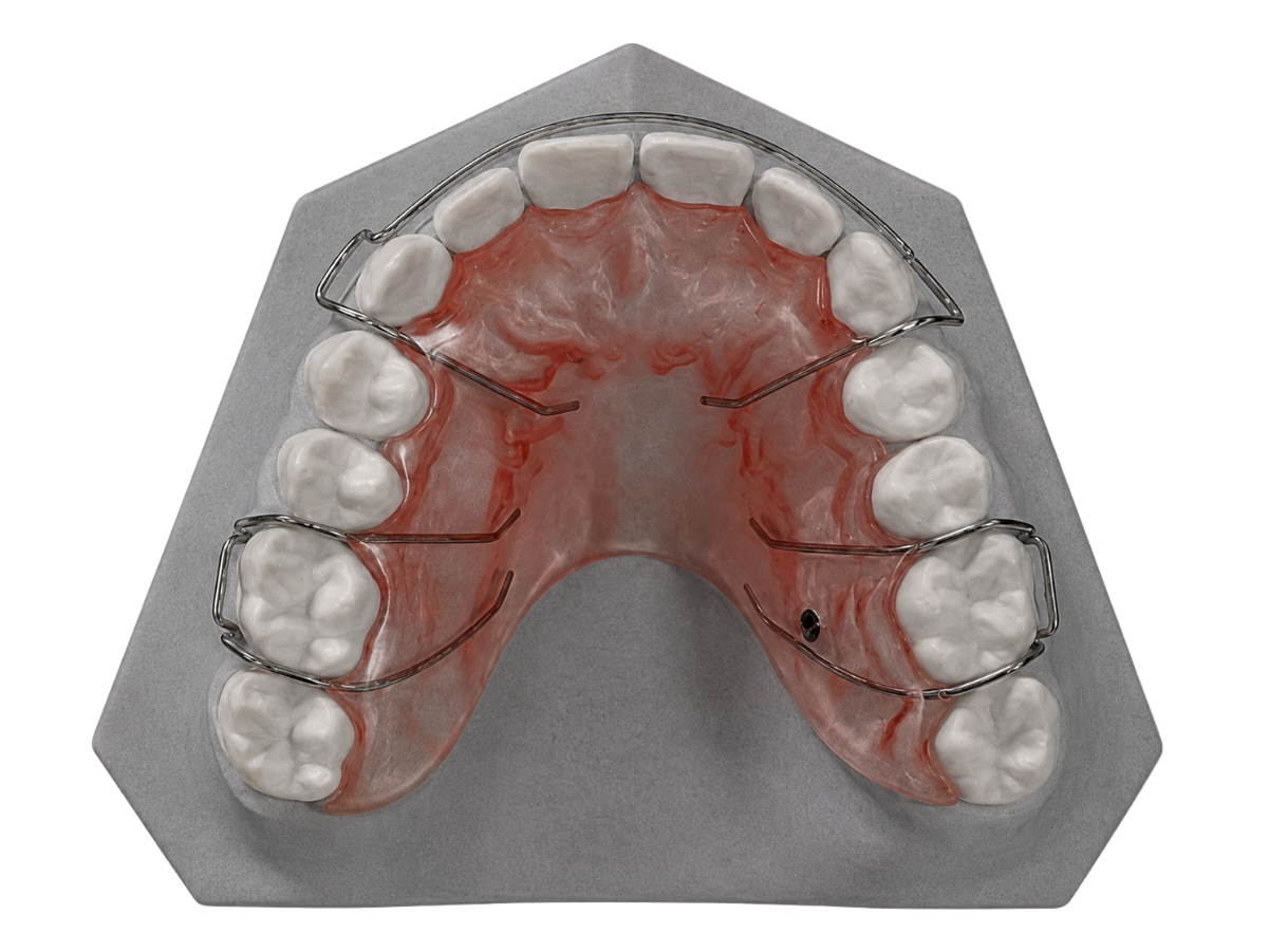 An orthodontic retainer on an upper model