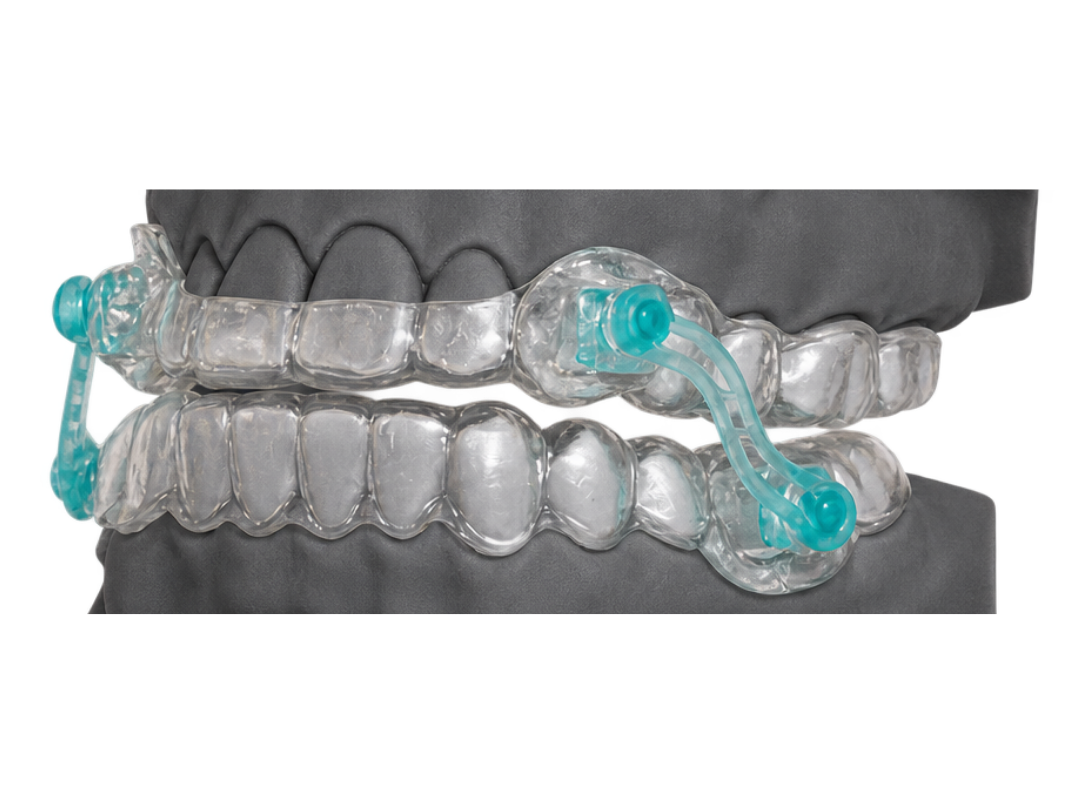 A sleep appliance on articulated study models
