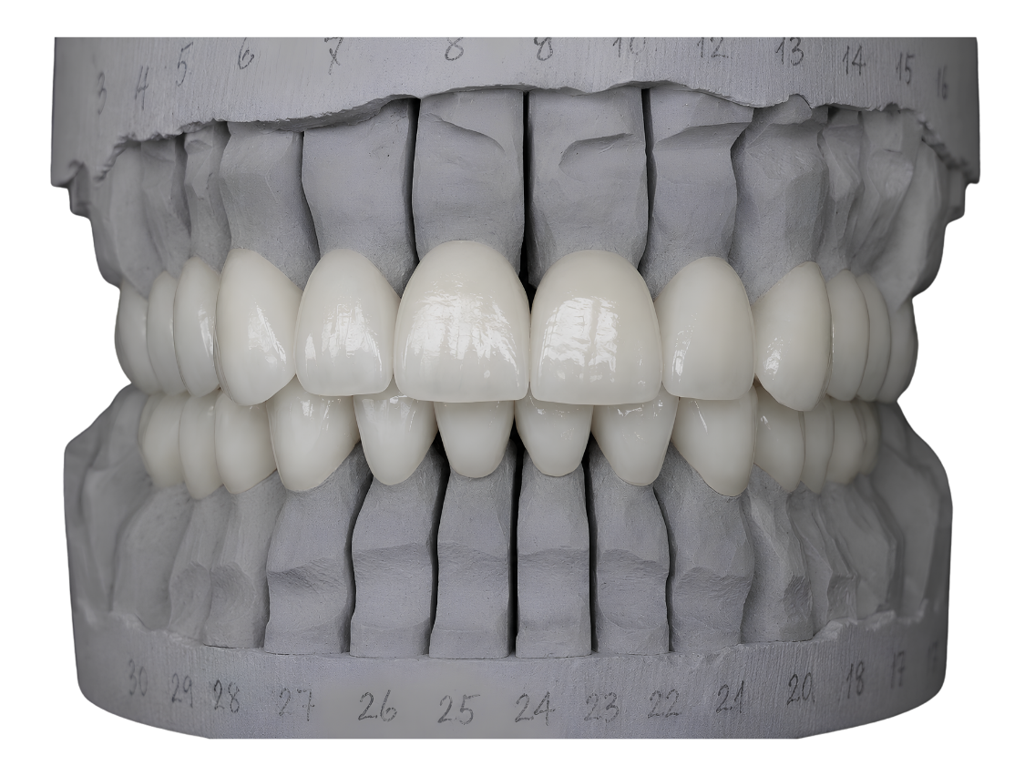 A zirconia full-arch restoration on a working model