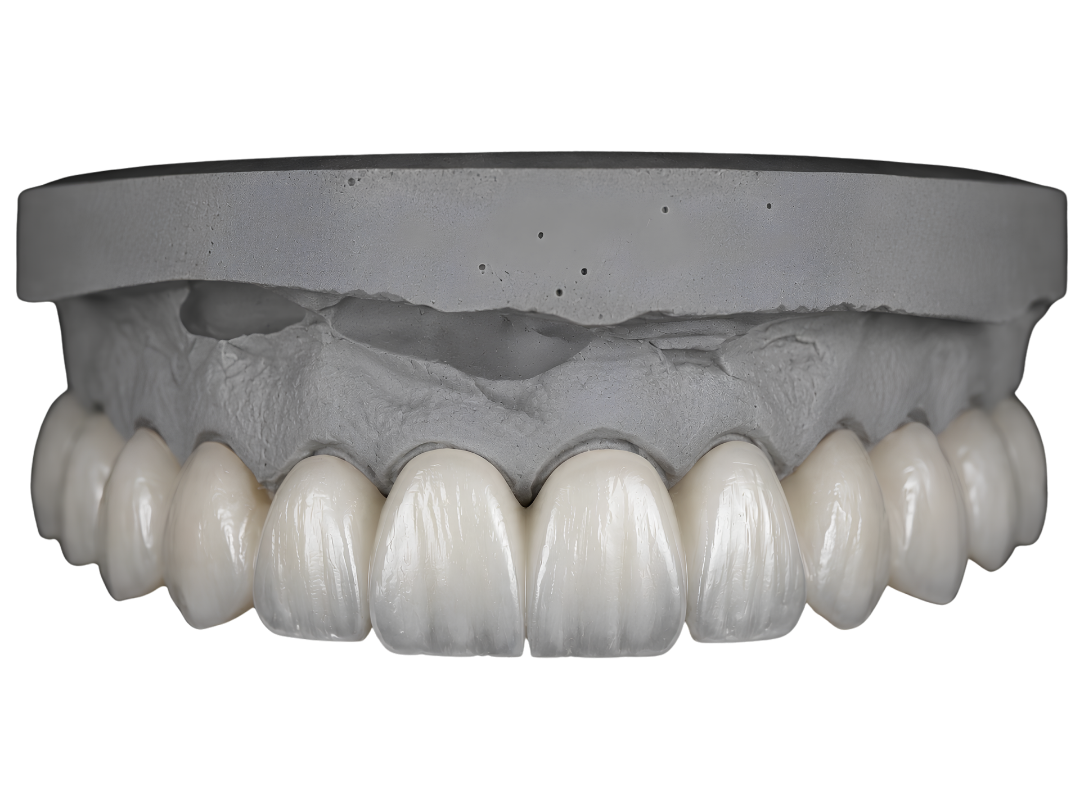 A layered zirconia bridge on a sectioned die model