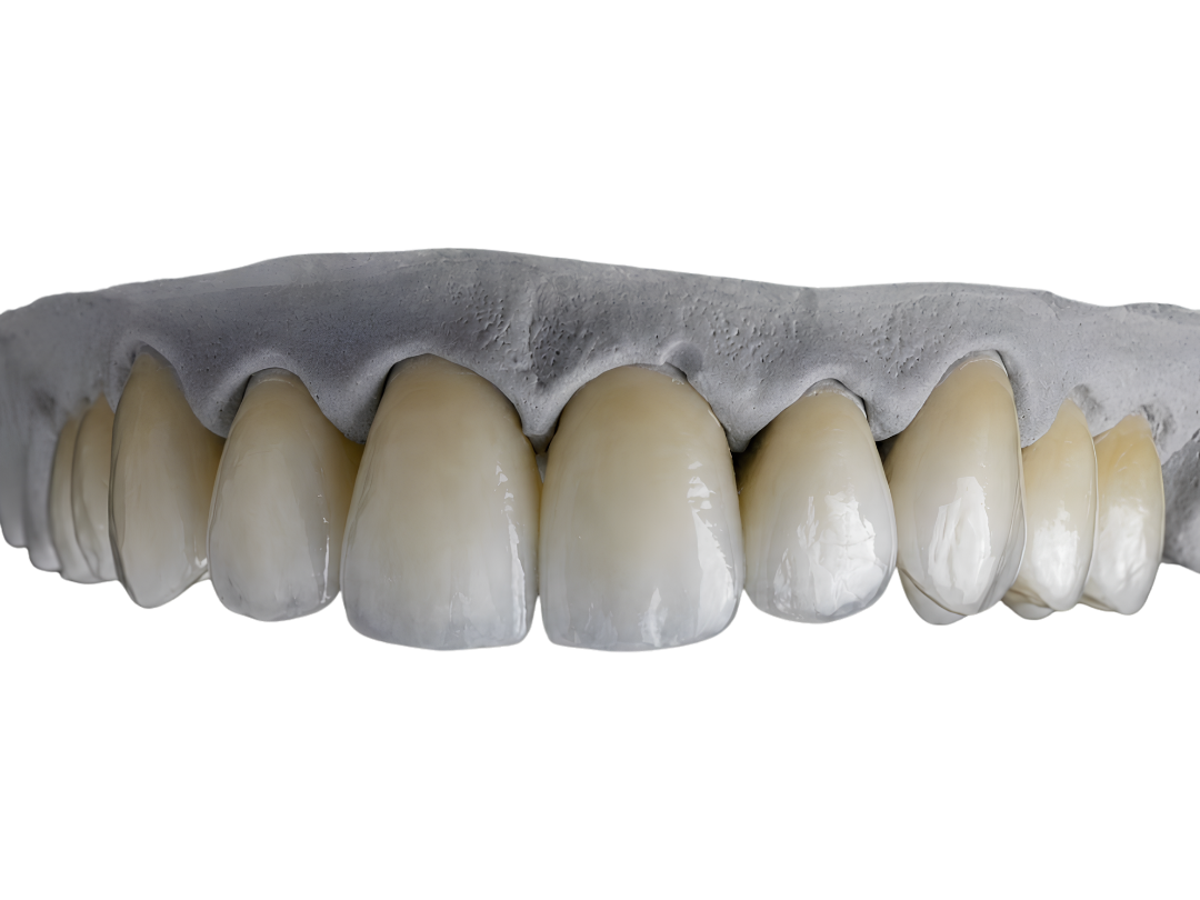 Multilayered zirconia units showing the shade gradient