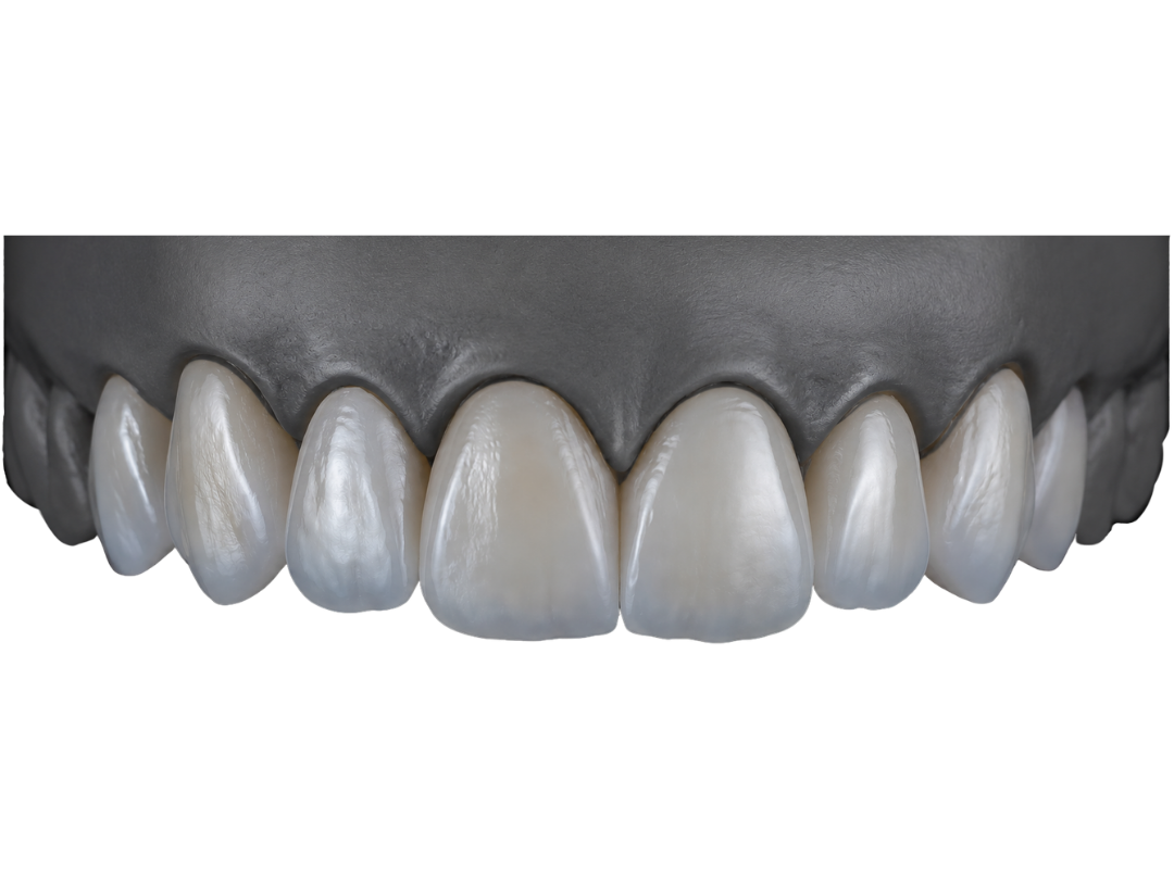 Zirconia veneers on an anterior model